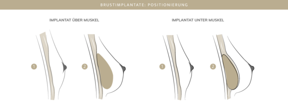 Brustimplantate, Plastische & Ästhetische Chirurgie in Mannheim, Dr. Schumacher
