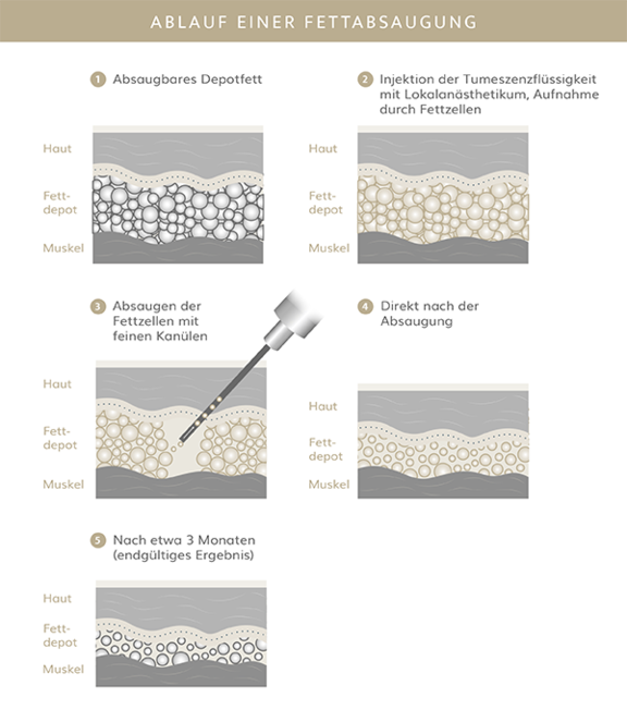 Fettabsaugung, Plastische & Ästhetische Chirurgie in Mannheim, Dr. Schumacher