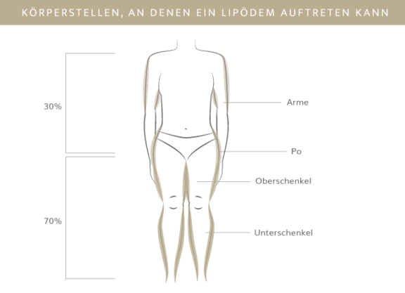 Körperstellen Lipödem, Plastische & Ästhetische Chirurgie in Mannheim, Dr. Schumacher