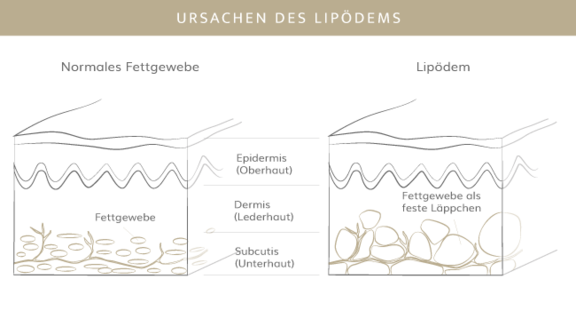 Ursachen Lipödem, Plastische & Ästhetische Chirurgie in Mannheim, Dr. Schumacher