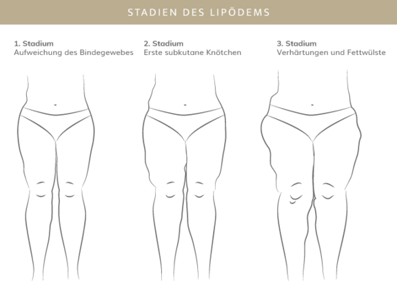 Stadien Lipödem, Plastische & Ästhetische Chirurgie in Mannheim, Dr. Schumacher